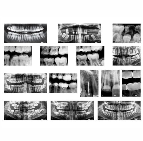 Dental X-Rays 10 X-Rays
